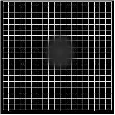 Central scotoma symptoms in an Amsler Grid