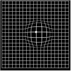 Macropsia symptoms seen in amsler grid