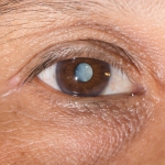 Eye with cataract