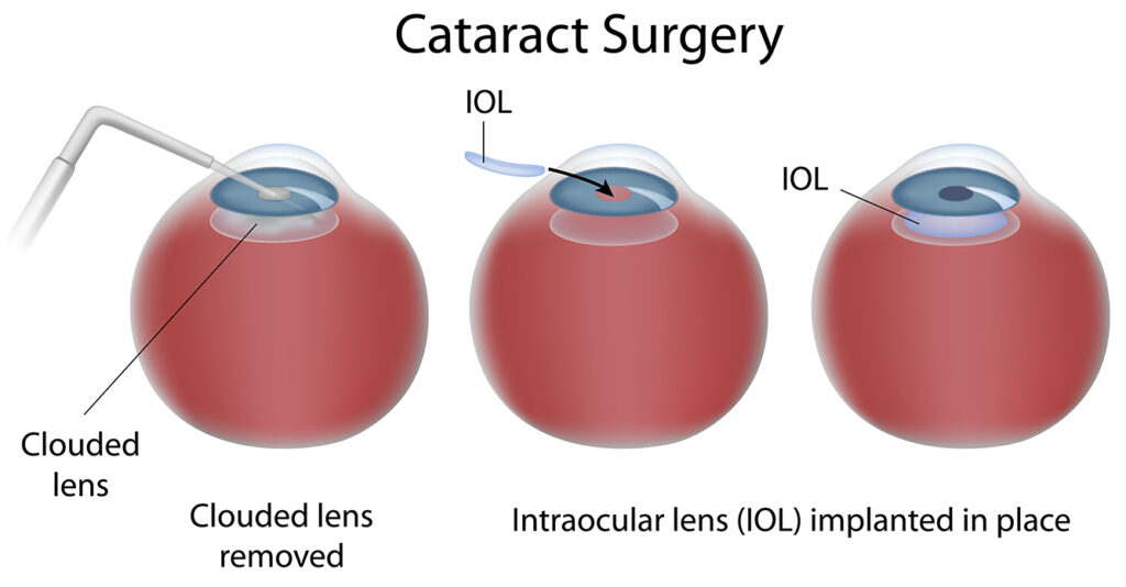 Cataract Surgery Steps
