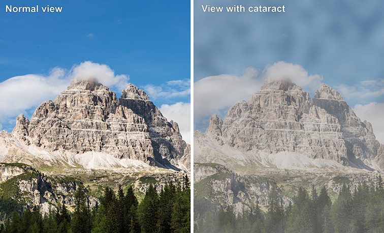 Comparison between a normal view and view of patient suffering from cataract