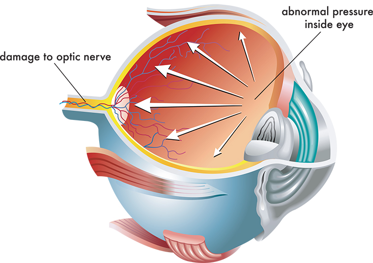 Diagram of Glaucoma pressure