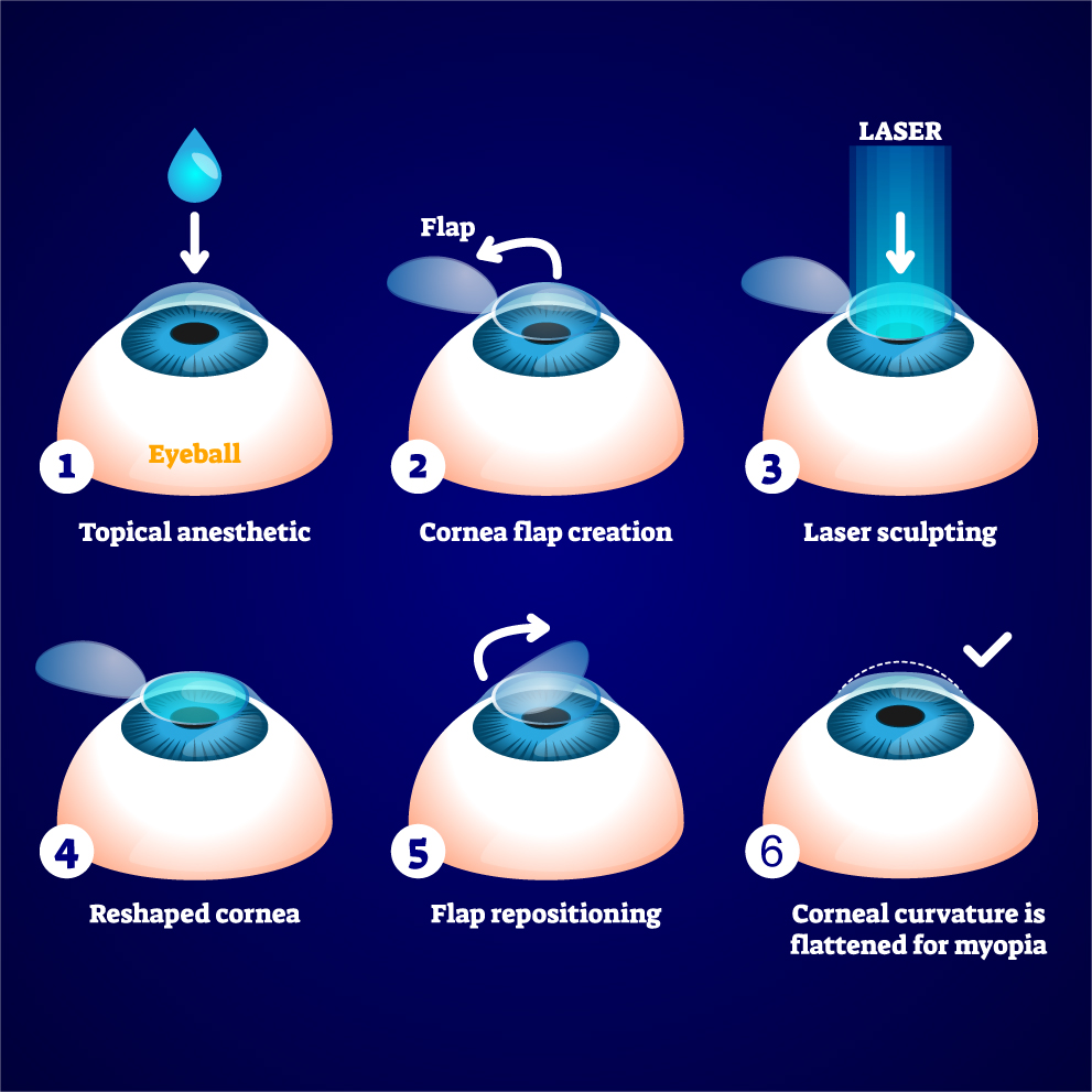 Illustration of the LASIK Procedure steps